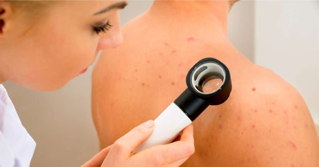 best acne scars removal treatment in lahore, best doctor for skin specialist in lahore