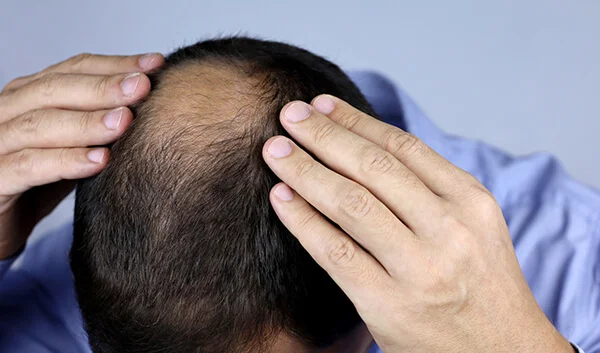 Androgenetic alopecia showing male pattern hair loss with receding hairline