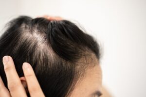 Hair follicle changes linked to alopecia mucinosa