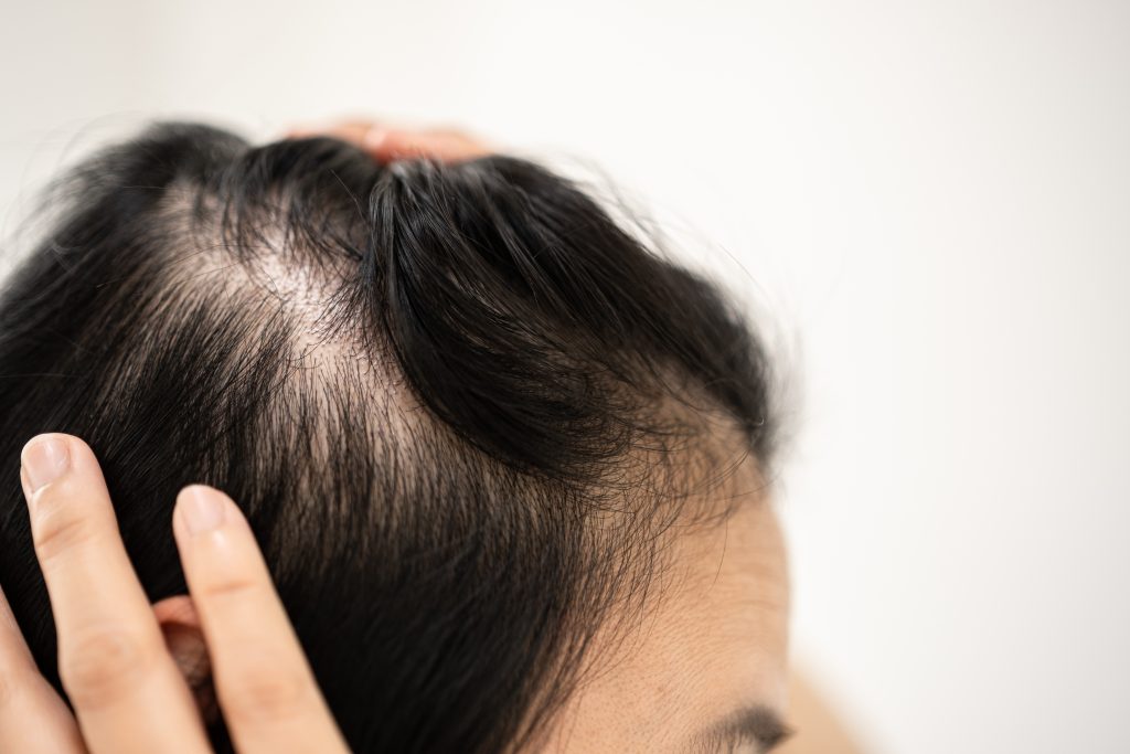 Hair follicle changes linked to alopecia mucinosa