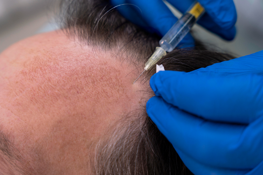 Specialist performing a hair transplant procedure