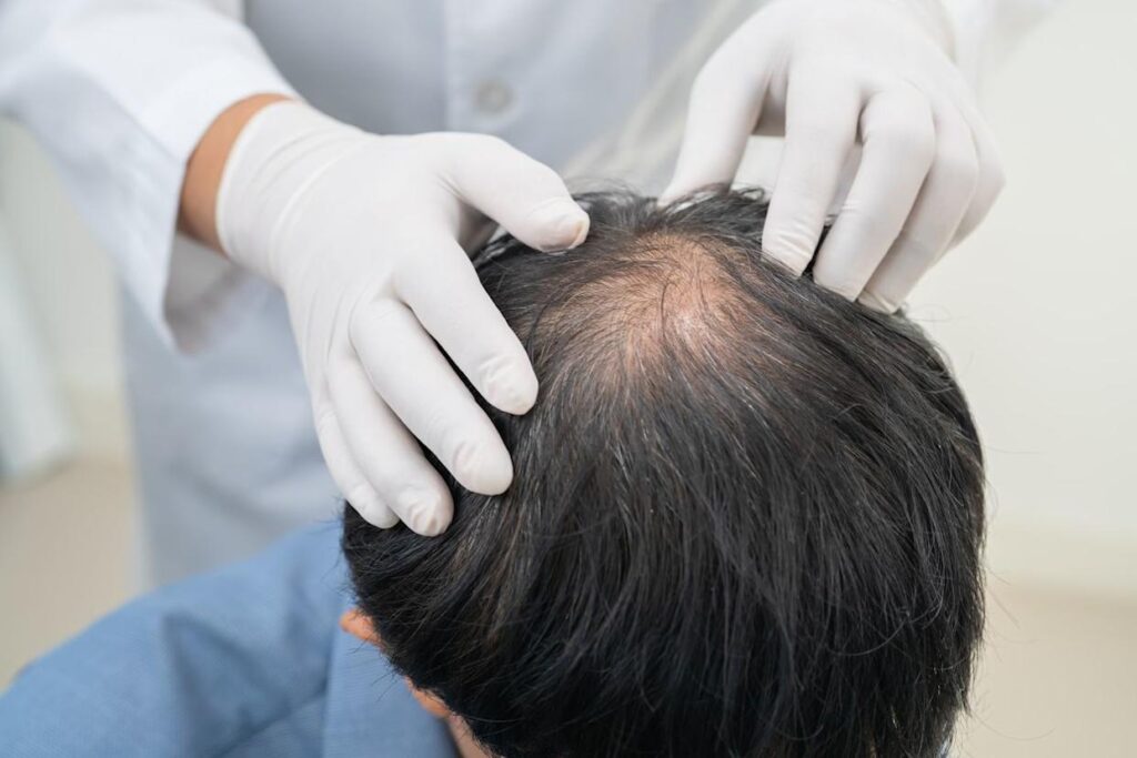Hair transplant surgery for permanent hair loss treatment