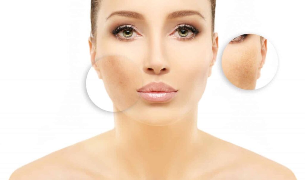 Skin discoloration with uneven white patches due to Tinea Versicolor