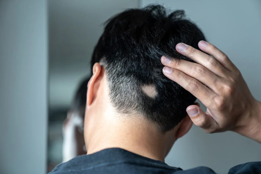 Alopecia areata showing patchy hair loss on scalp