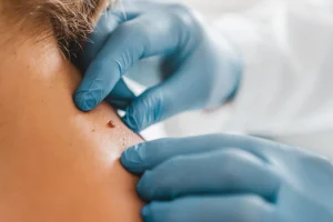 How_to_remove_skin_tags