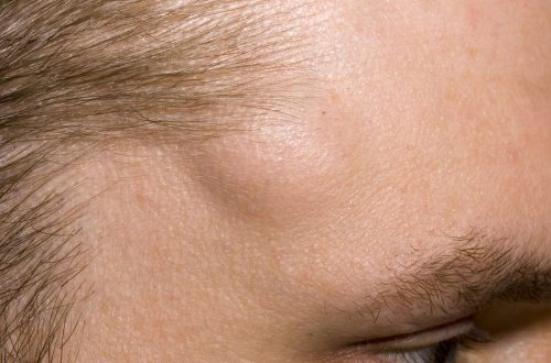 Lipoma