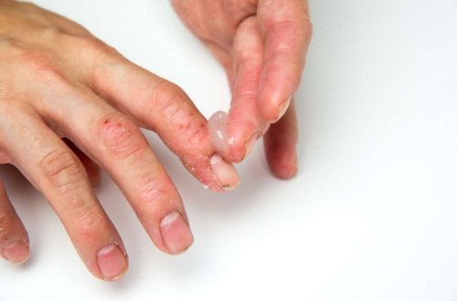 nail fungus removal treatment in Lahore, best dermatologist in Lahore