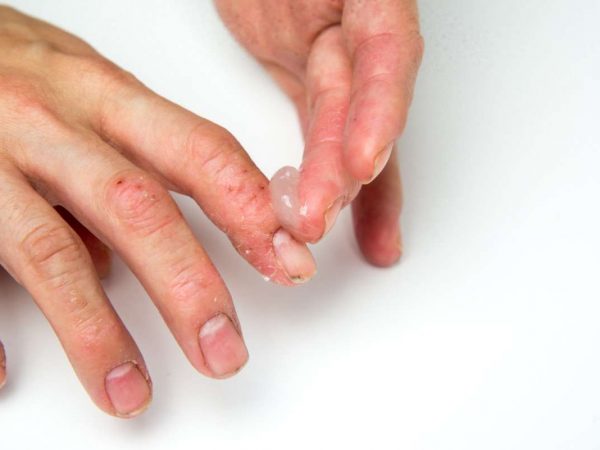 nail fungus removal treatment in Lahore, best dermatologist in Lahore