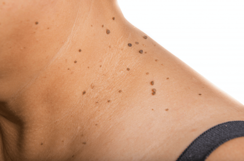 Tag removal treatment in Lahore, best mole removal treatment in Lahore