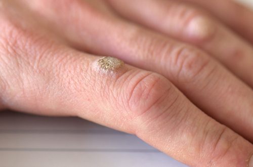 Warts
