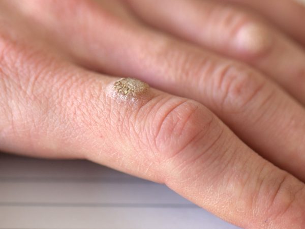 Warts
