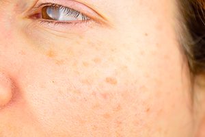 age-spots-on-womens-cheek