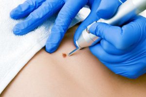 blog-dermatology-cryosurgery-skin-mole-1080x675