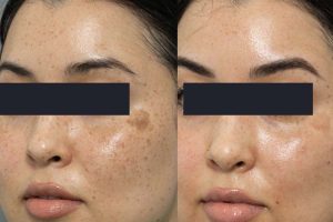 pico-laser-pigment-removal-treatment